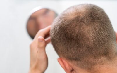 ¿Cómo Combatir la Caída del Cabello en Hombres?